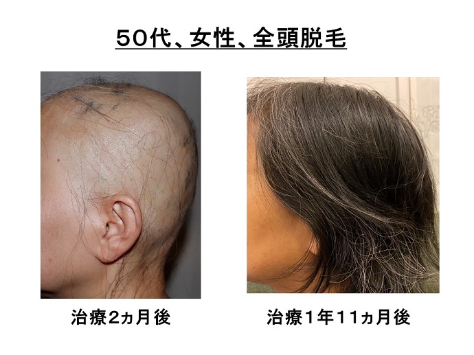 汎発性脱毛　病院